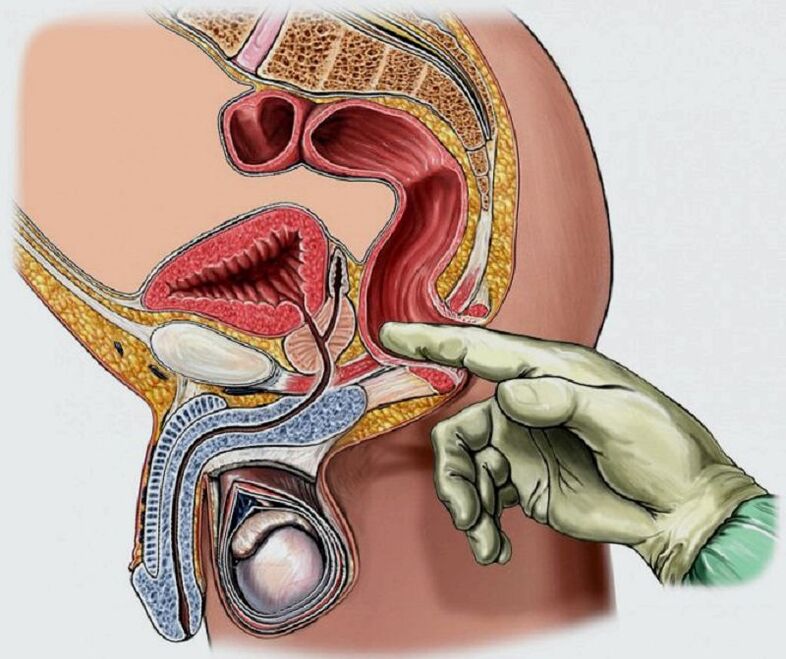masaje prostático para la prostatitis